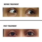 Pre and Post Treatment